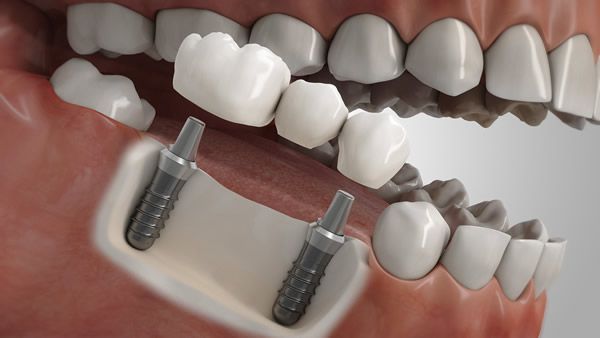 Implantat für mehrere Zähne Illustration eines Implantats als Ersatz für mehrere Zähne nebeneinander