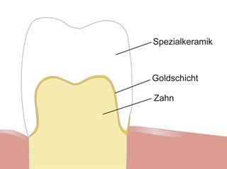 Galvanokrone Illustration einer Galvanokrone