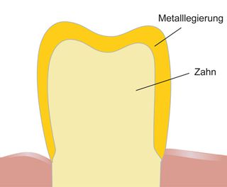 Vollgusskrone Illustration einer Vollgusskrone